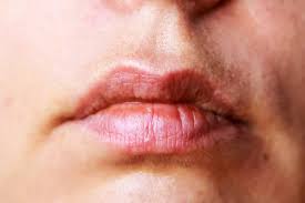 herpes on the corner of the lips images