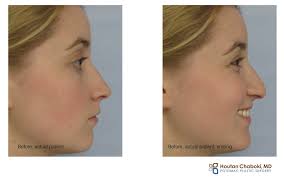 improving a droopy nasal tip with