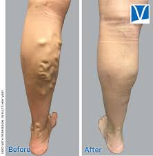 But since insurance policies vary from person to person. Varicose Veins Before And After What To Expect For Vein Surgery