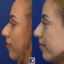 non surgical rhinoplasty achieve a
