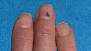 blood under my nail or is it melanoma