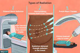 radiation therapy for lung cancer