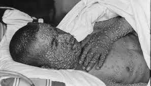 The ancient scourge smallpox was relegated to biowaste bin of history more than 30 years ago, the result of the world's first and only successful disease eradication programs. Why Do We Need A New Smallpox Vaccine Global Biodefense