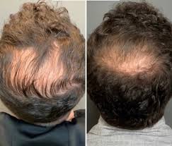non surgical hair loss treatment