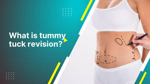 what is tummy tuck revision are