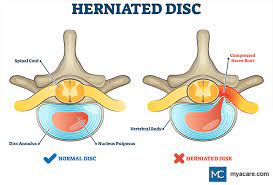 surgery for a herniated disc