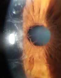 Corneal Dystrophies 101 Lasik Essex