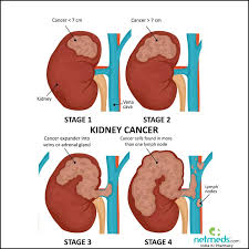 kidney cancer causes symptoms and