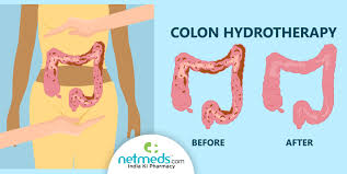 colonic irrigation what is it will it