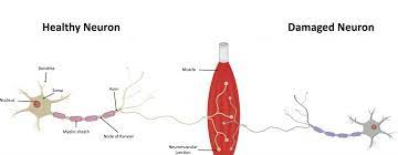 seaweed treating motor neurone disease