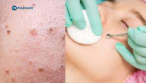 deep rooted blackheads removal