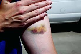 unexplained bruising causes treatment