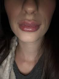 how long after lip fillers should they
