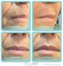 laser treatment for upper lip lines