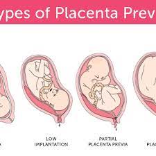 In many cases, a diagnosis of placenta previa in the early weeks (usually before week 20) may correct itself as the pregnancy progresses. Types Of Placenta Previa Www Google Com Download Scientific Diagram