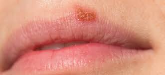 herpes triggers diagnosis