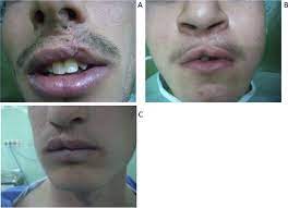 epidemiology of lip and palate clefts