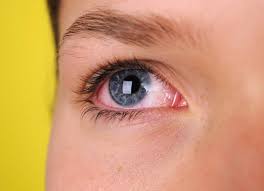 bloodshot eyes causes diagnosis and