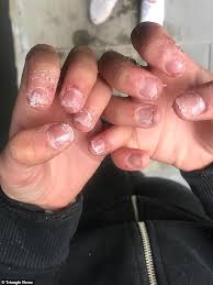 I wore nails for years and it took months for my nailbeds perfect toenails and the acrylic is pink, so no polish flaking. Teenager Warns Against Fake Nails As Nails Shredded After Getting Acrylics Daily Mail Online