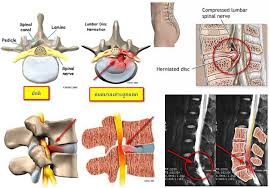 spinal cord stenosis คือ