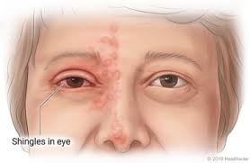 shingles of the eye care instructions