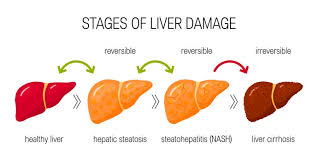 6 Tips To Reduce Fatty Liver Disease Common Complication Of