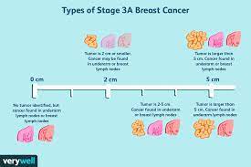 stage 2a and stage 2b. Stage 3 Breast Cancer Types Treatment Survival