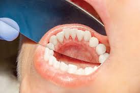 mouth sores berwyn cancers