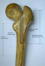 railroad proximal fem osteotomy