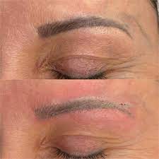 glycolic acid microblading removal and