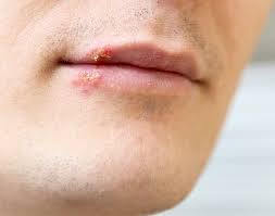 cold sores fever blisters cers of