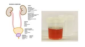 blood in urine rela hospital