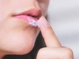 cold sore on lip pictures treatments