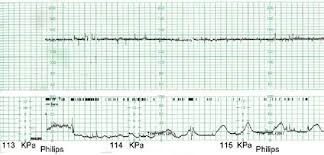 Note Fixed Fetal Heart Rate Pattern With Loss Of Variability