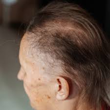 chemo hair loss is focus of antibody