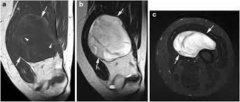 extremity myxoid liposarcoma diagnosis