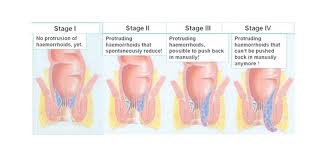 The acute management of haemorrhoids. Piles Hospital Treatment Surgery Diagnosis In India Rg Hospitals