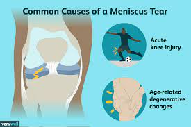 meniscus tears symptoms causes