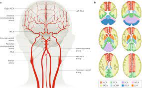 Stroke is a heterogeneous syndrome caused by multiple disease mechanisms, but all result in a disruption of cerebral blood flow with subsequent tissue damage. Ischaemic Stroke Nature Reviews Disease Primers