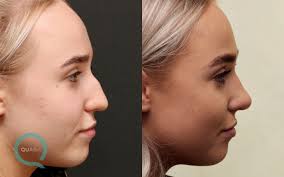 We did not find results for: Before And After Nose Job Photos Quaba Plastic Surgery Edinburgh Uk