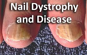 nail dystrophy and disease contour