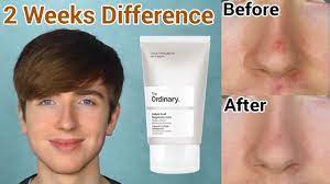 The issue is that when i apply it after the ordinary's azelaic acid, the azelaic acid seems to come off while i'm applying the oil in like, little clumps. Fade Red Marks From Acne The Ordinary Skincare Azelaic Acid Results Post Inflammatory Erythema Youtube