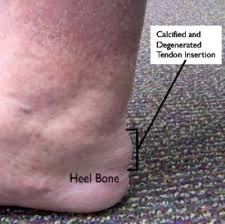 The achilles tendon is the largest and strongest tendon in the human body. Achilles Tendinitis Orthoinfo Aaos