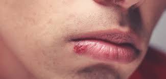 It may result in small blisters in groups often called cold sores or fever blisters or may just cause a sore throat. Herpes Simplex Virus Oral And Genital Herpes Poz