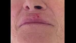 clinical challenge a lip lesion and a
