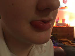 sudden huge swelling on ds s lip mumsnet