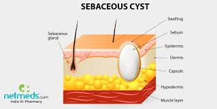 sebaceous cyst causes symptoms and