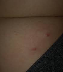Bumps hsv 2 pictures on buttocks. Pimple Boil Or Herpes On Buttocks Genital Herpes Simplex Forums Patient