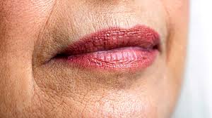 unwanted lip lines treatment and causes