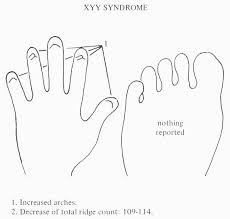 4 Hand Charts For Cri Du Chat Syndrome